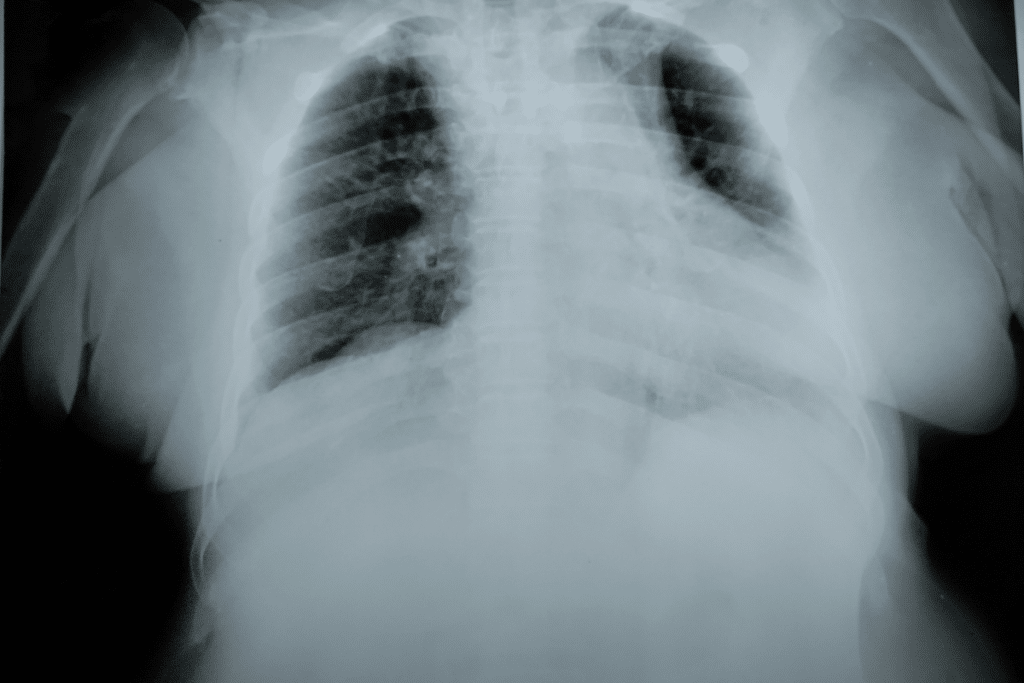 la radiographie thoracique